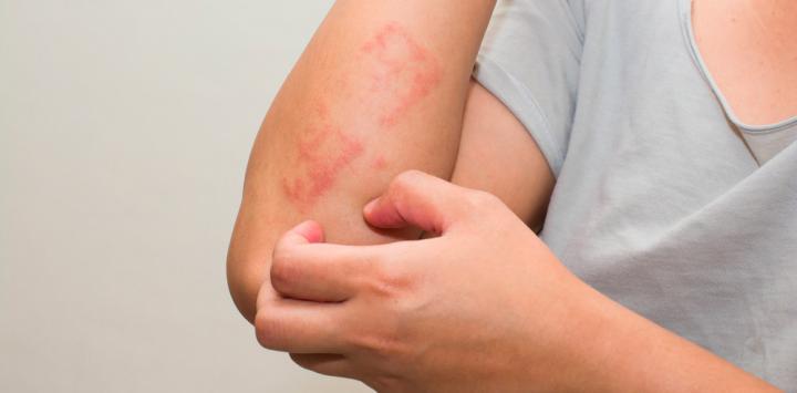 Se aprueba nueva terapia que mejorará la vida de pacientes con Psoriasis Pustulosa Generalizada en México