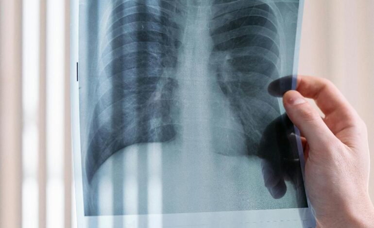Innovadora molécula de Boehringer Ingelheim frena deterioro en Fibrosis Pulmonar