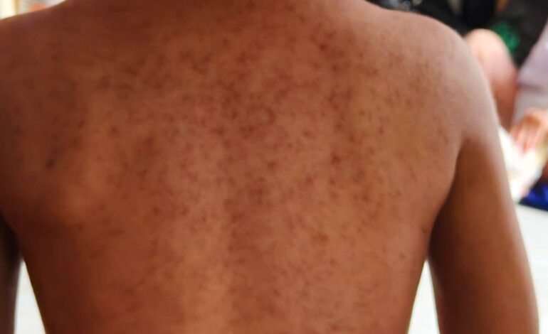 getty images sarampion 185855