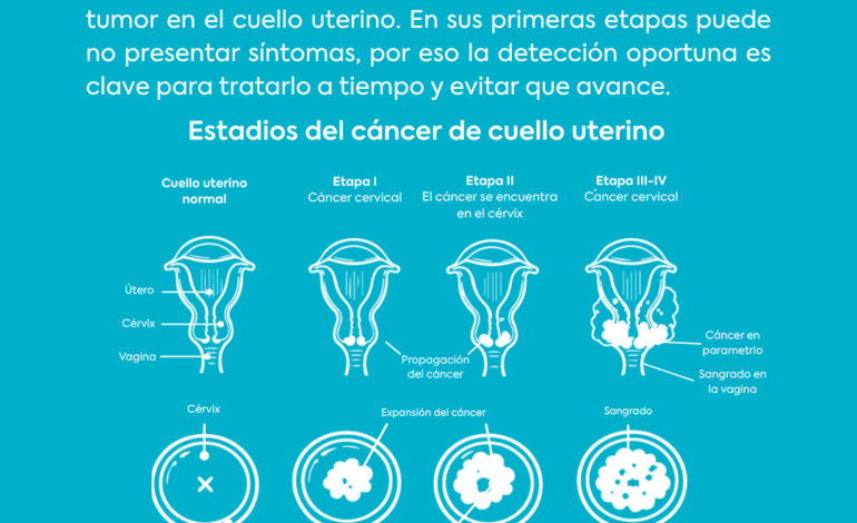 Cancer de cuello uterino
