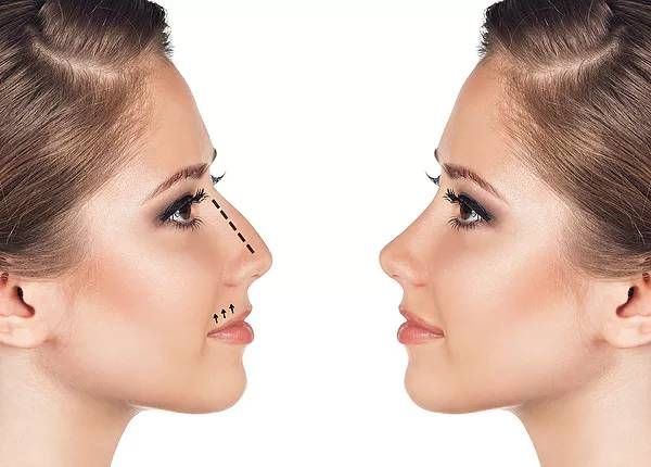 rinoplastia ultrasonica en mexico la mejor opcion para tu nariz