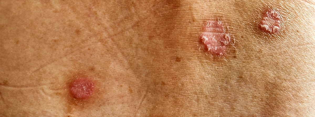 31 millones de personas en México viven con alguna enfermedad de la piel. ¿Cómo reconocer la Hidradenitis Supurativa?